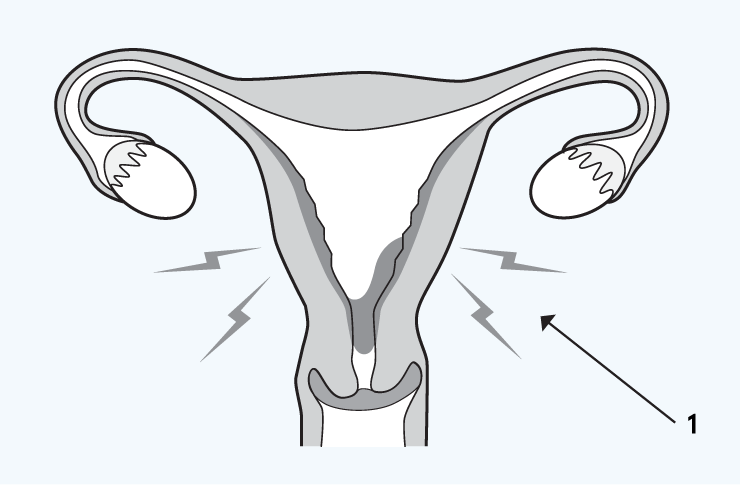 CS-Teleabortion-cramps-and-bleeding-illustration Public bone location