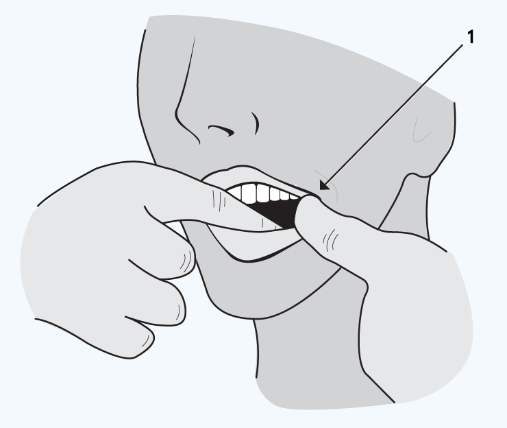 CS-Teleabortion-tablets-are-absorbed-through-your-cheek-illustration Tablets are absorbed through your cheek illustration