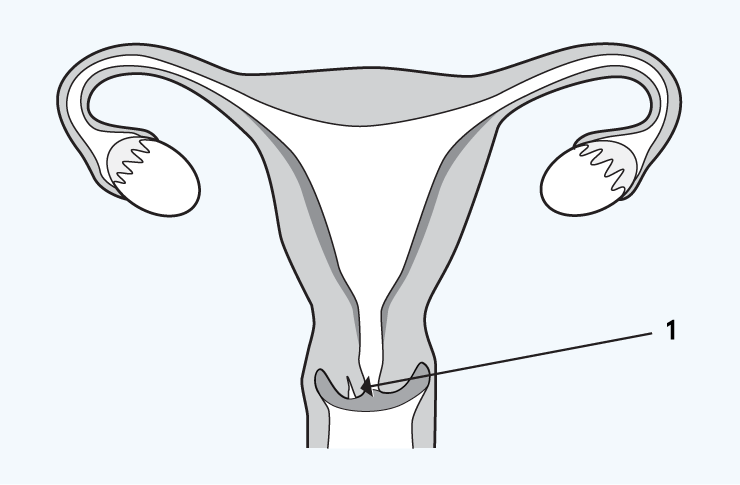 damage-or-tearing-of-the-cervix Damage or tearing of the cervix