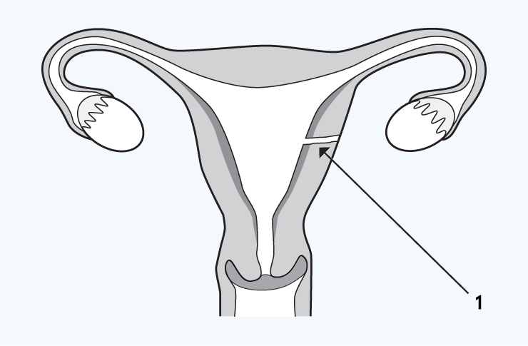 perforation-of-the-uterus Perforation of the uterus