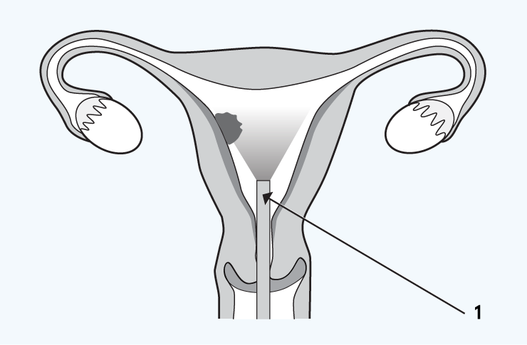 pregnancy-is-removed-with-gentle-suction Pregnancy is removed with gentle suction