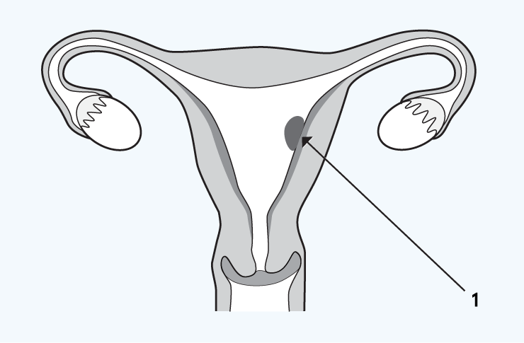 retained-clot-or-pregnancy Retained clot or pregnancy illustration